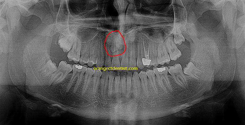 X-ray radiograph showing mesiodens in a patient in our dentist office in Orange, CT