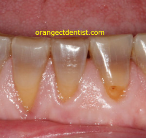 tetracycline staining teeth photo at Orange and West Haven CT dentist