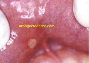 Photo aphthous ulcer or canker sore on lower lip