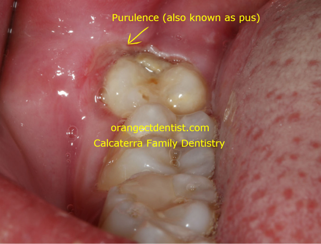 Quality photograph or photo of pericoronitis with a wisdom tooth
