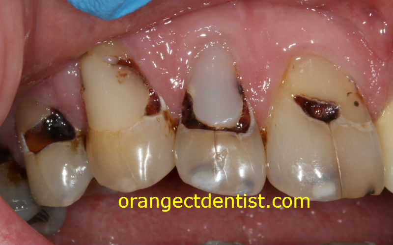 Photo of teeth with decay from dry mouth or xerostomia from radiation treatment