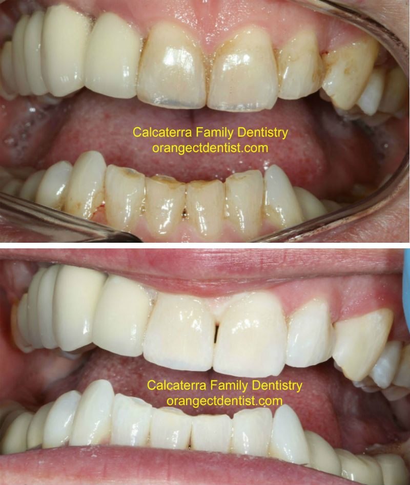 Before and After Teeth Whitening Zoom Orange and Milford and Woodbridge, CT