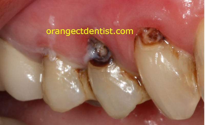 photograph and picture of cavities from dry mouth with ropey saliva
