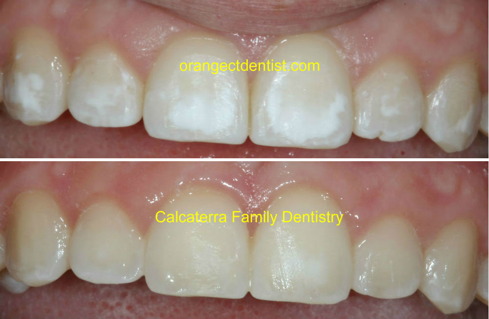 Non invasive white spot treatment before and after photos at the dentist after braces and orthodontics