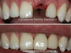 Before and after photo of dental implant for patients in Orange and Woodbridge CT