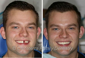 Before and After photo and picture of dental implants for a front tooth.