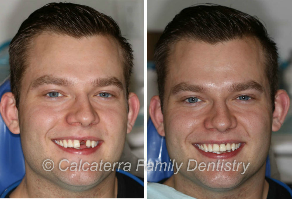 Dental Implants photo and picture showing Tom smiling in our Orange, CT dentist office.