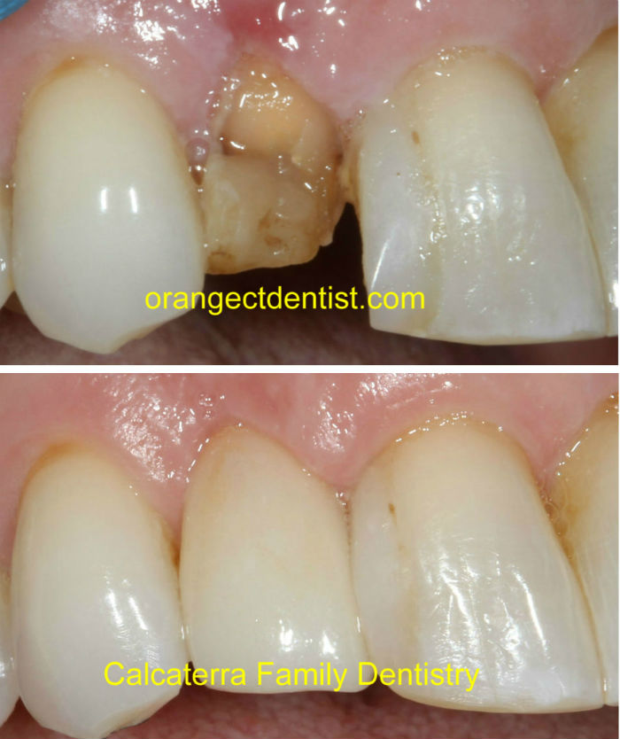 Dental crown lengthening in our Orange and Milford, CT office before and after photos