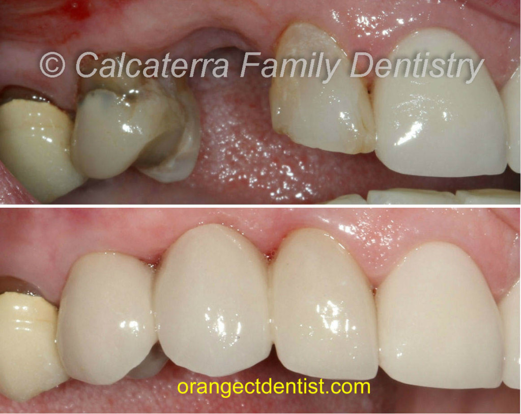 Before and after bridge photo for missing canine teeth or tooth
