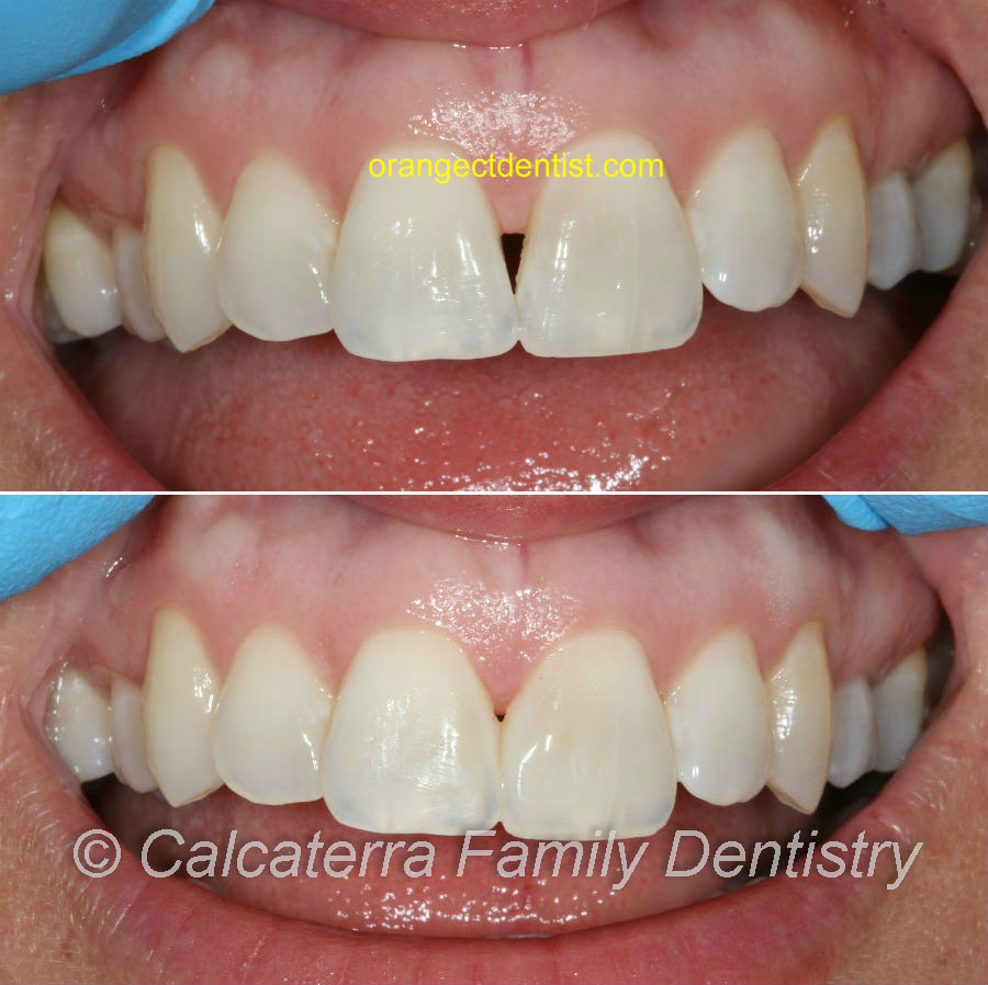 Before and after picture of dental bonding to eliminate black triangle
