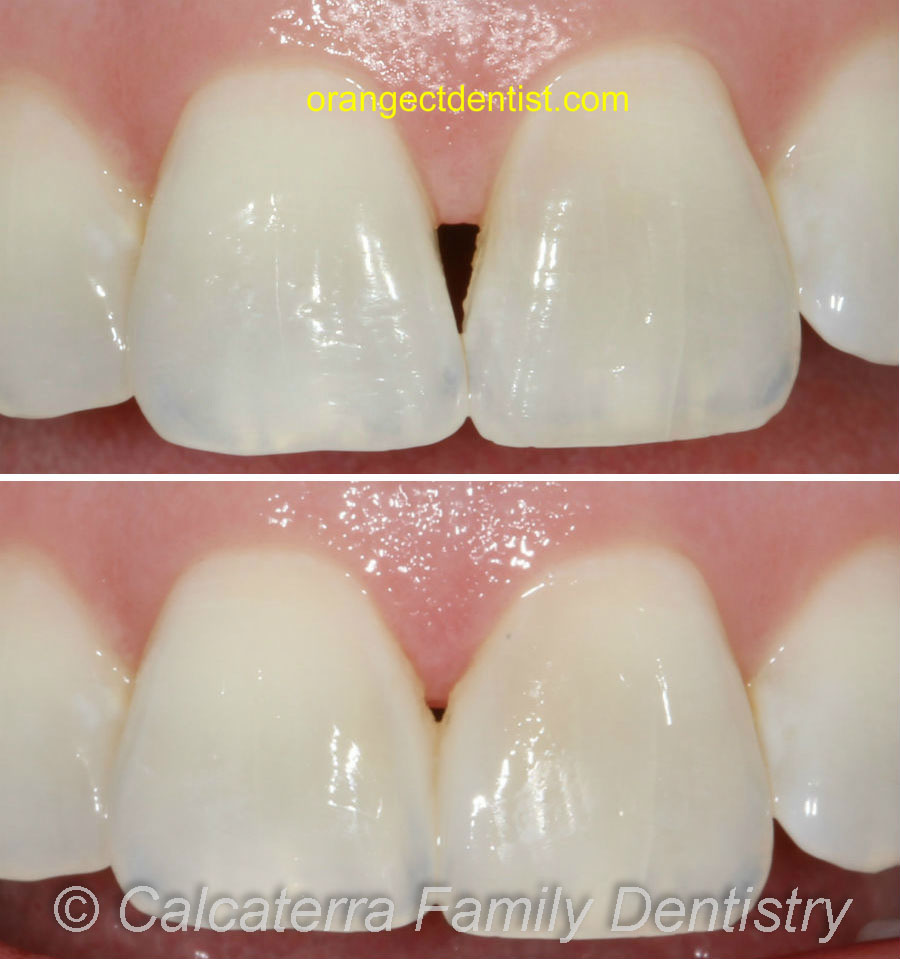 Before and after photo of dental black triangle being fixed with bonding