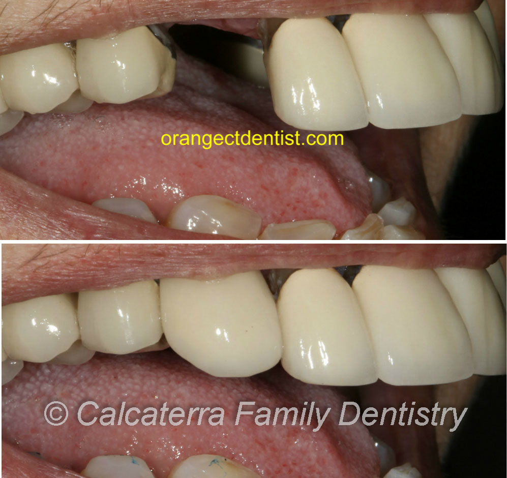 Ugly dental implant before and after photo at Calcaterra Family Dentistry