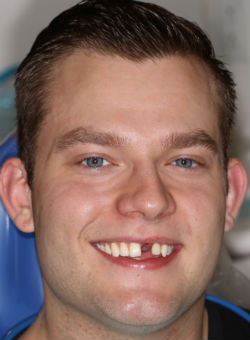 A beautiful pre-operative dental implant photo