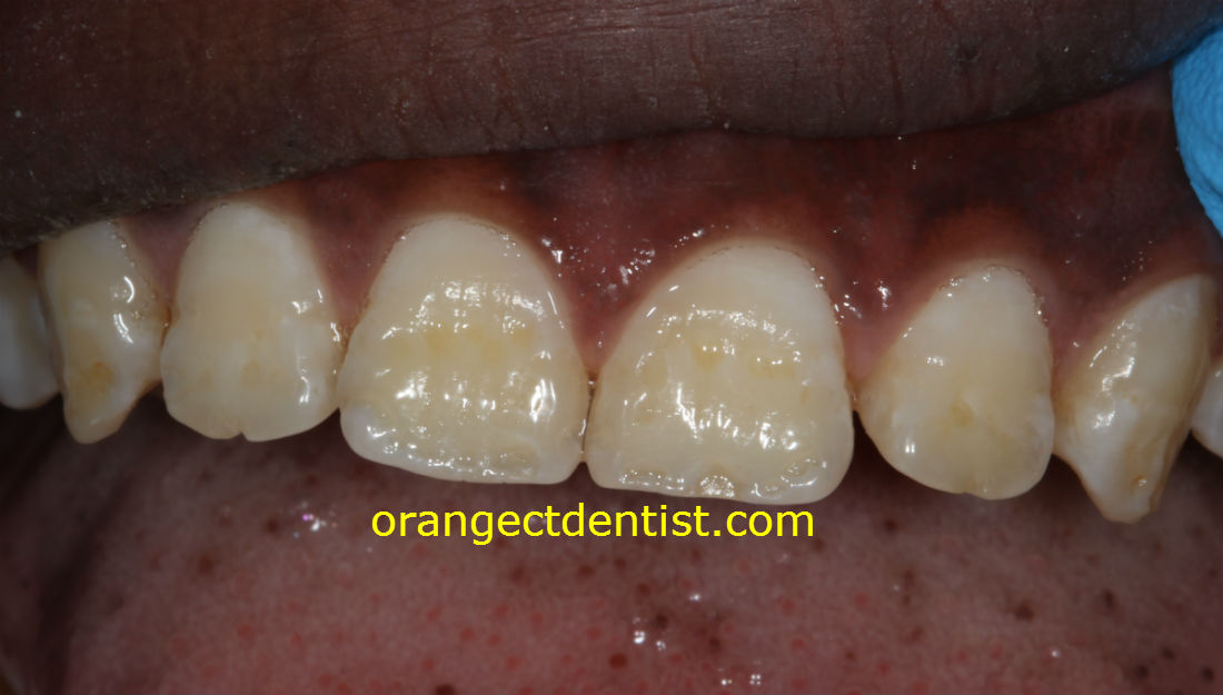 Detailed photo of dental fluorosis seen on adult incisor teeth