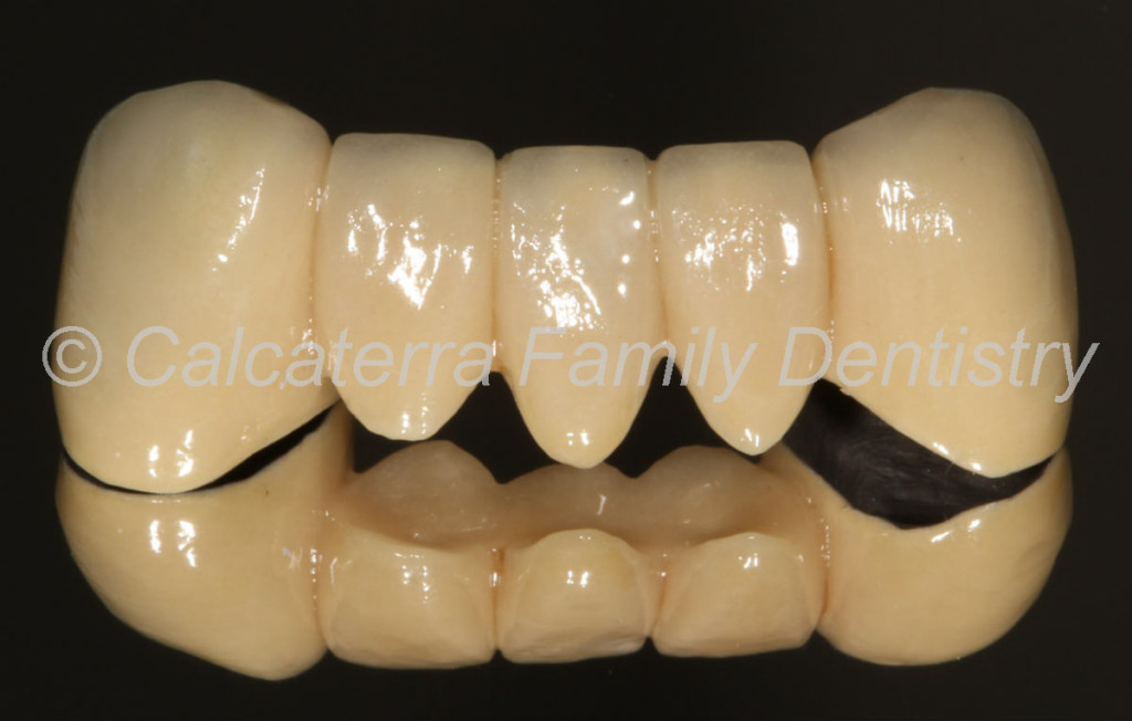 cool dental bridge photo showing teeth and pontics