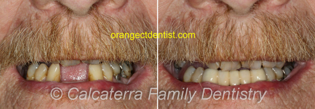 Lower dental bridge with canines and incisors before and after photos