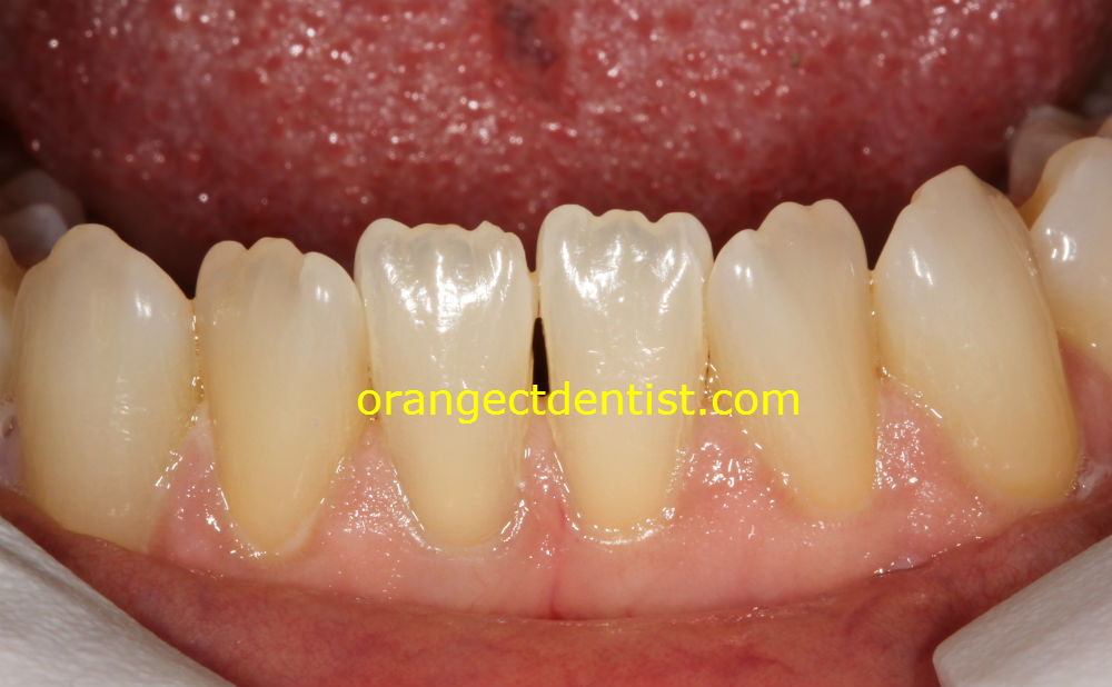amazing quality photo of teeth mamelons on adult lower incisors
