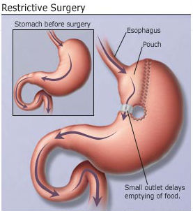 weight loss surgery diagram which leads to decay
