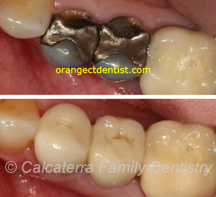 Before and After photos of all ceramic and porcelain dental crowns