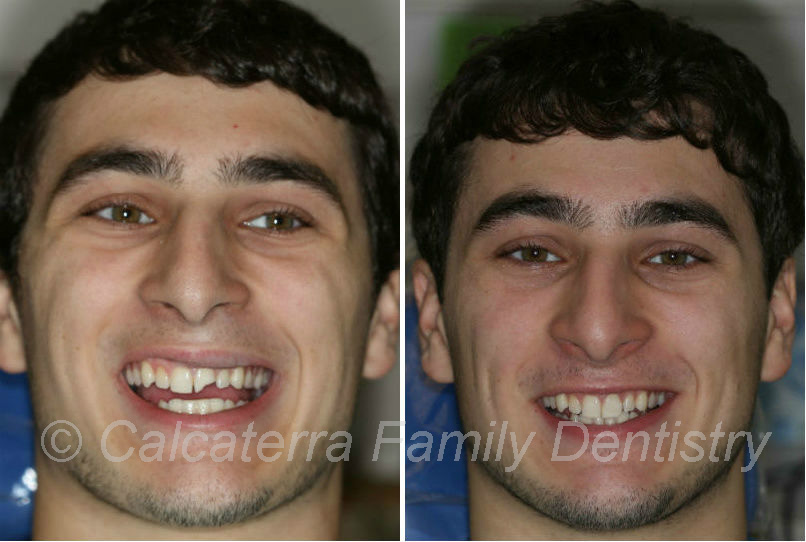 Hockey Puck damage to front tooth before and after photos of dental work
