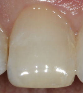 single tooth photo