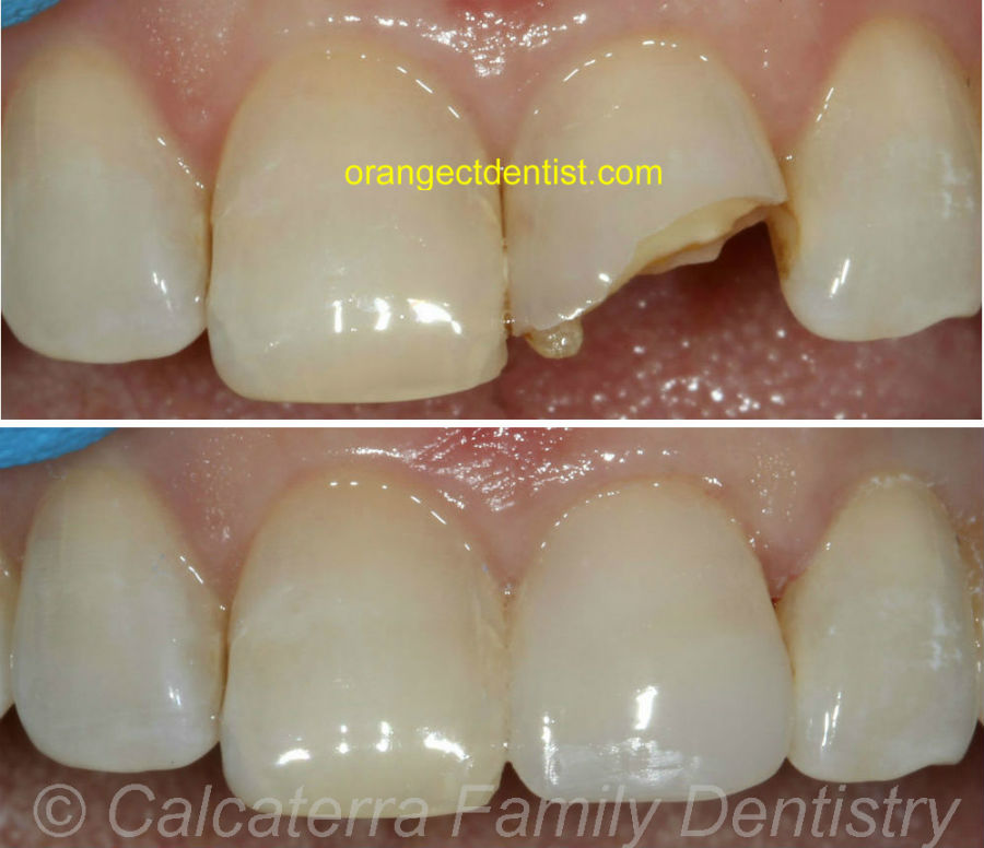 Before and after photos showing broken front tooth fixed with bonding
