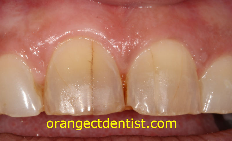 teeth grinding photo showing cracks and craze lines on front teeth