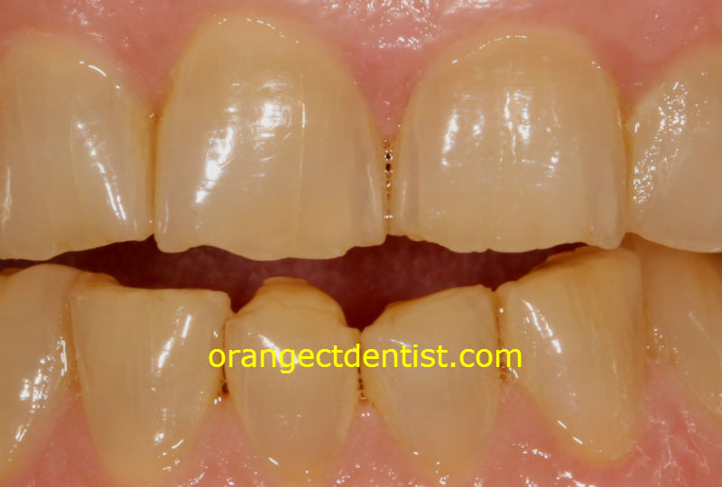 wear of teeth from grinding and bruxism photo