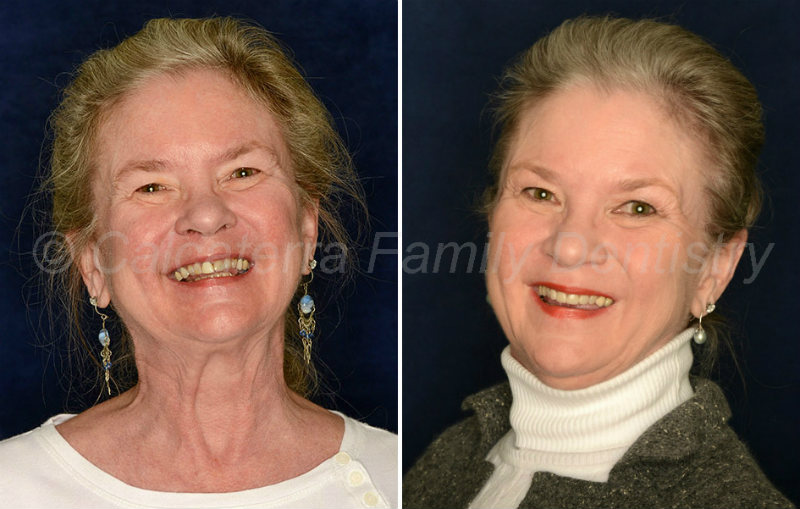 Before and after portrait photos showing dental porcelain veneers on teeth