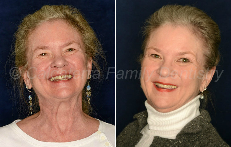 Christie before and after veneer and crown photos.