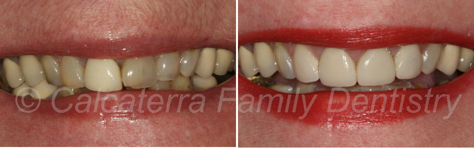 photos showing before and after of porcelain veneers on front teeth