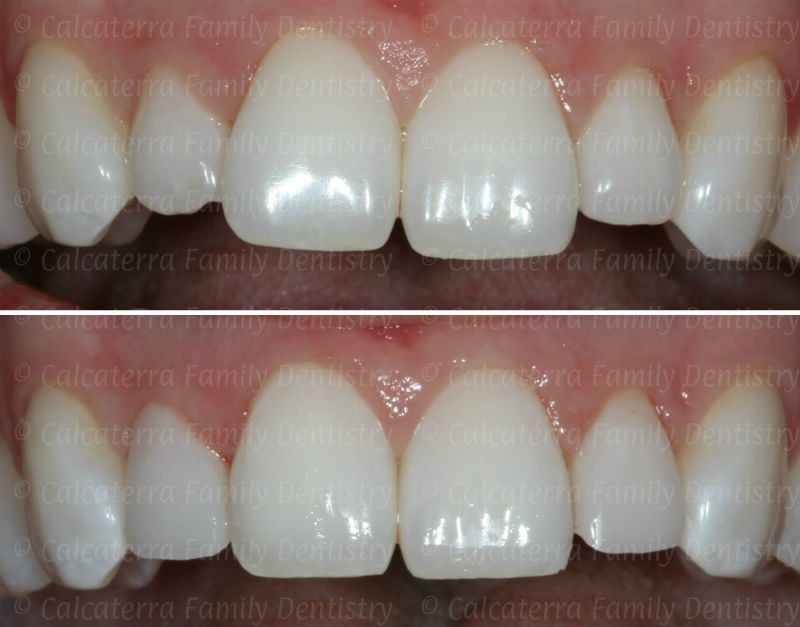 Before and After photos of cosmetic shaping of poorly shaped incisor teeth