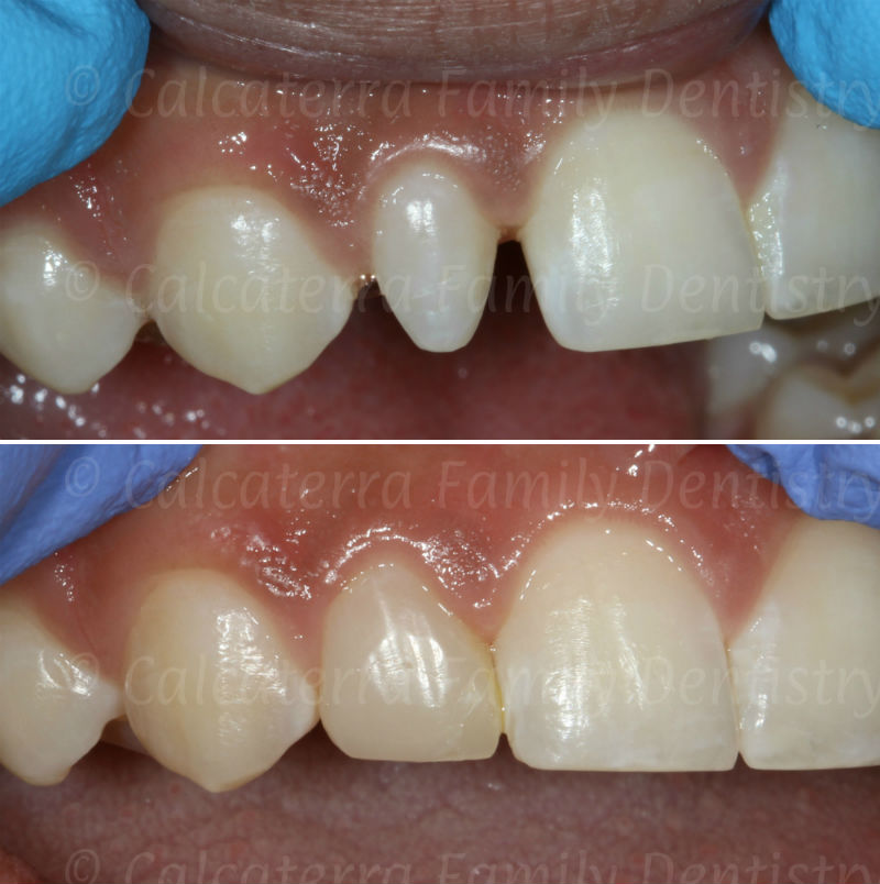 Before and after photo fixing peg laterail incisor with bonding