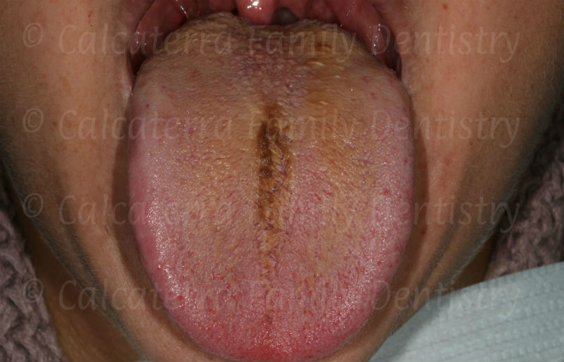 black hairy tongue photo seen at dentist office