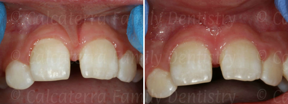 before and after laser frenectomy photos on a 10 year old patient before braces.