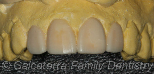 Wax-up of veneers to preview new teeth