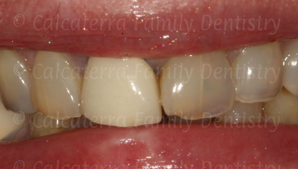 Front tooth crown with a bad color and shade match
