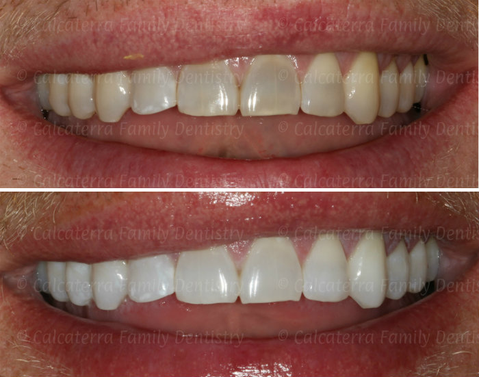 Kor Whitening Before and After photos at Orange, CT dentist