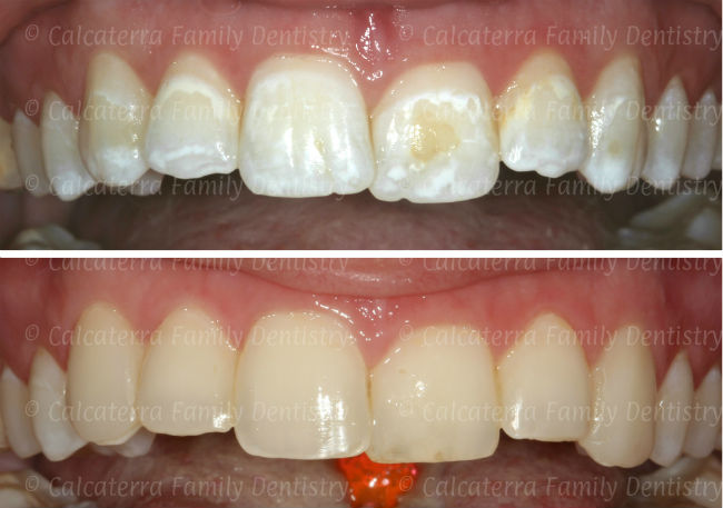 Before and after photos of white spots on teeth after braces fixed with dental bonding.