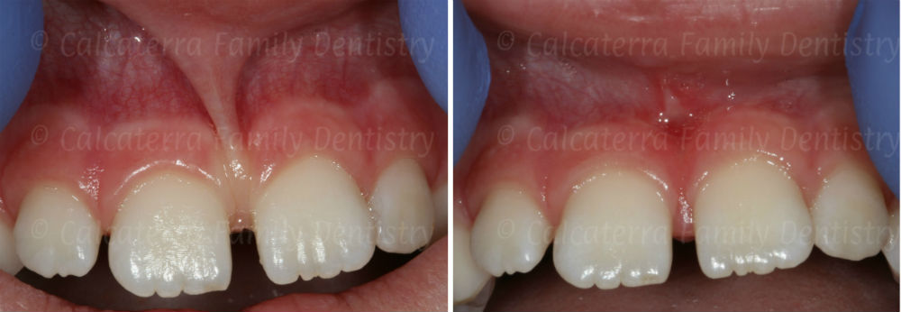 laser frenulectomy on a 7 year old before and after photograph