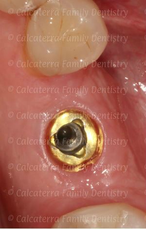 dental implant no cement next to it