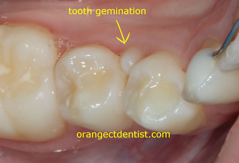 High quality photo of tooth gemination of a premolar.