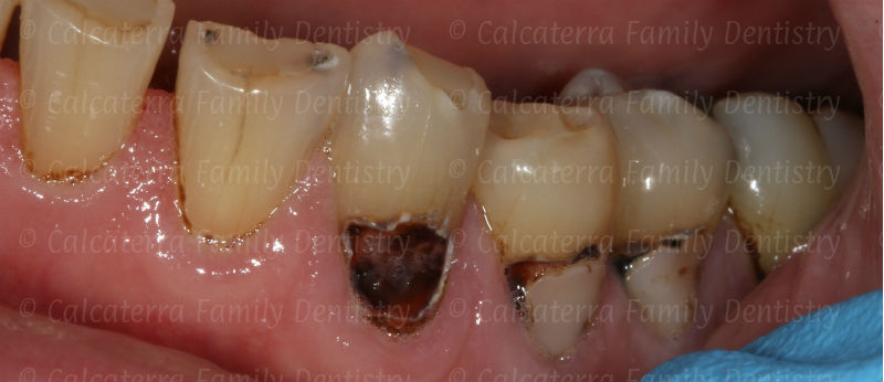 dental decay photo on a weight loss surgery patient showing cavities