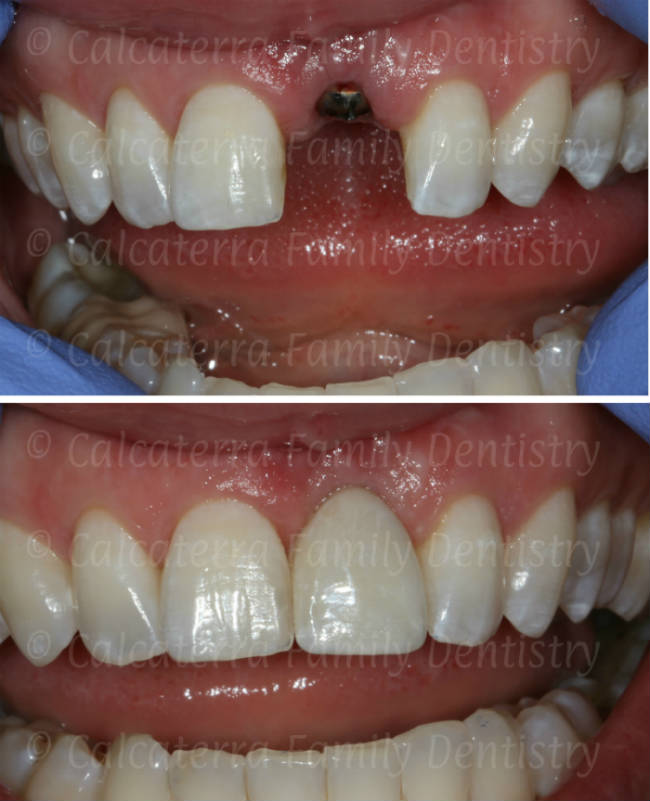 before/after dental implant photo
