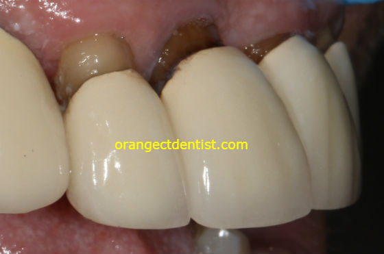 bad black lines on front tooth crowns