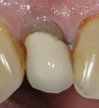 photo of a black line at the gumline of a dental crown