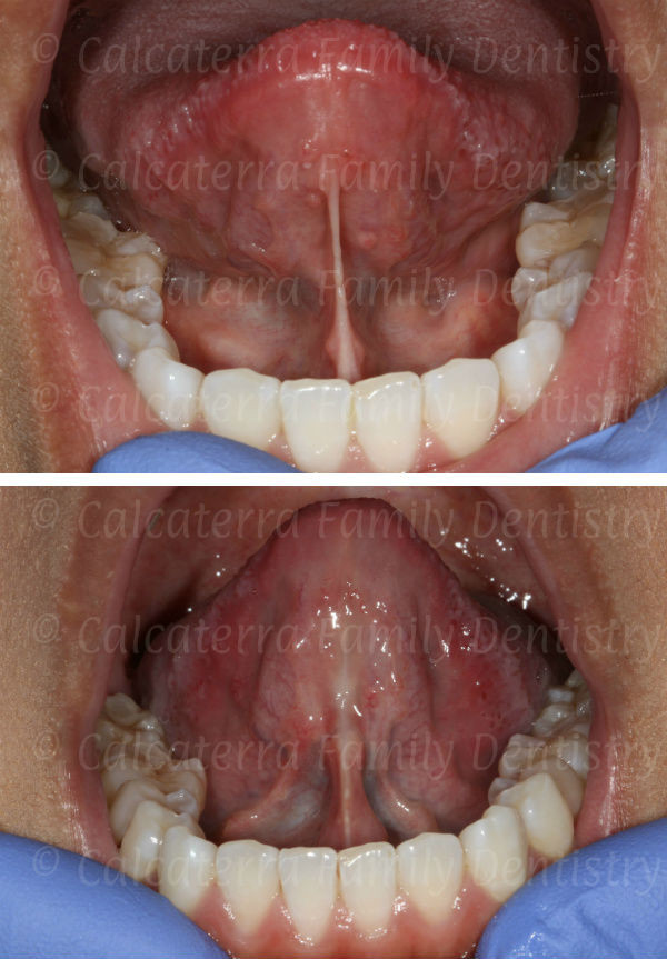 Before and after laser lingual frenectomy photogragh