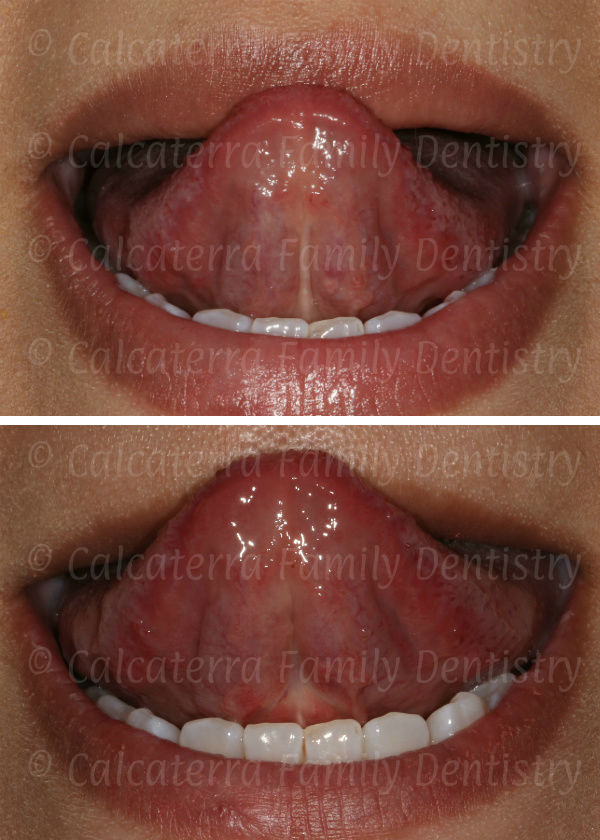 laser tongue tie before and after photos
