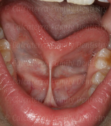 lingual frenum that will need a frenectomy by a dentist