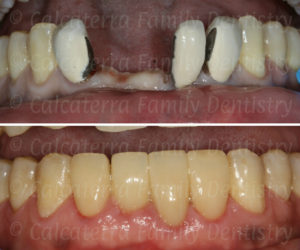 Before and after photo showing old bridge removed to his new smile